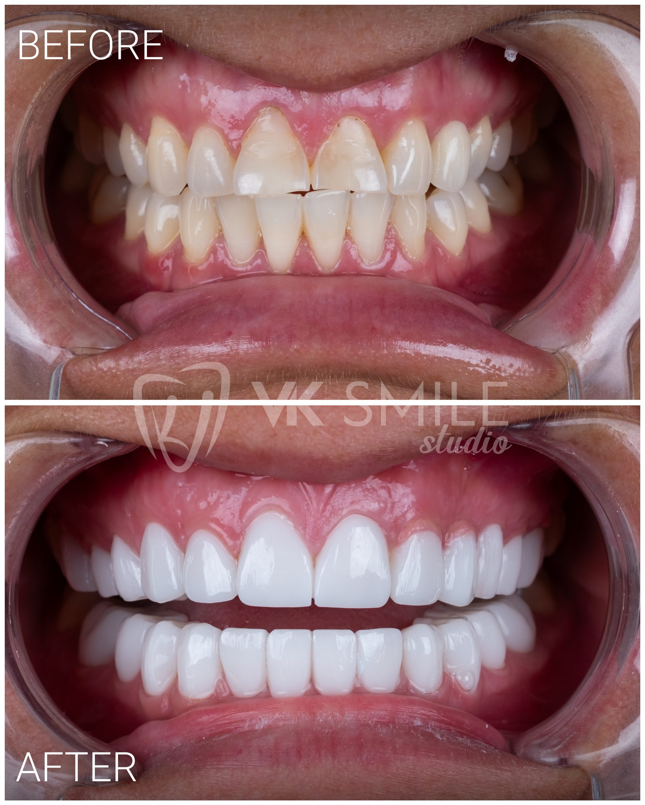 Dental crowns Turkey before after