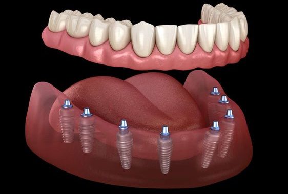 All on 8 dental implants in turkey