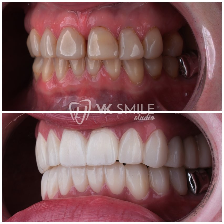 Natural zirconia crowns enhancing front smile