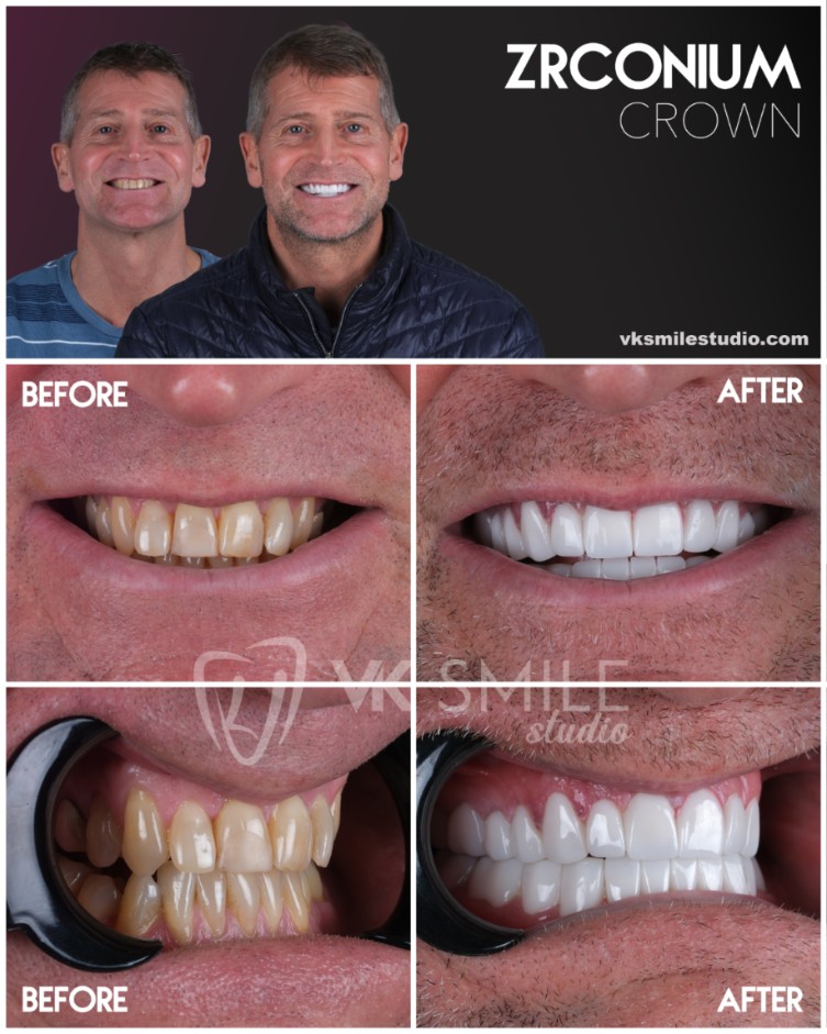 Zirconium crowns in Turkey