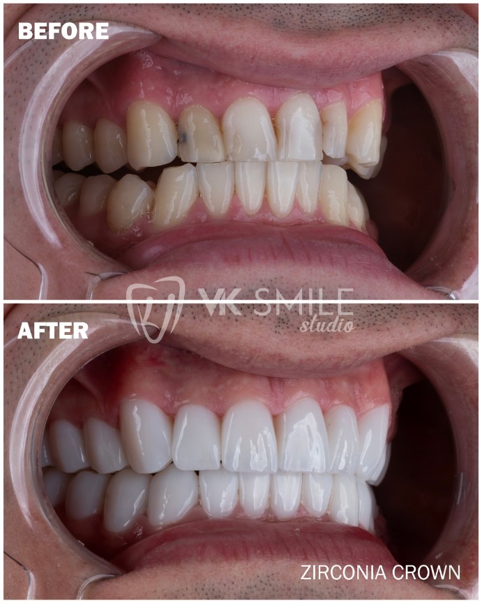 Dental crowns Turkey before after