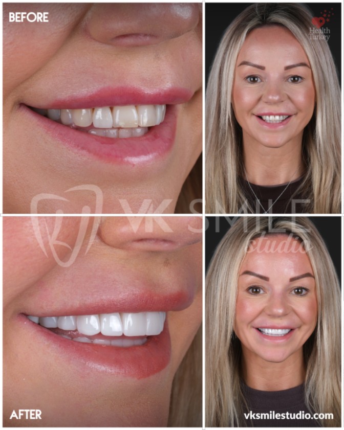 Dental crowns Turkey