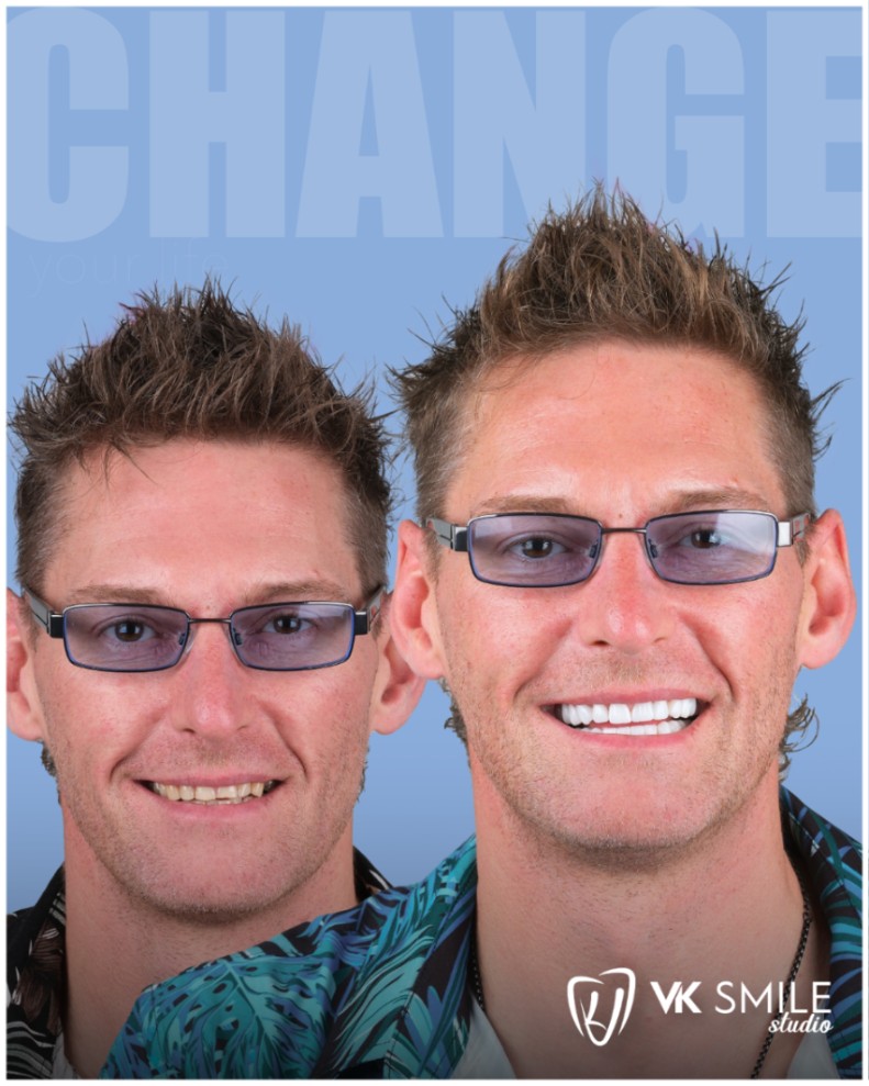 Before after teeth Turkey