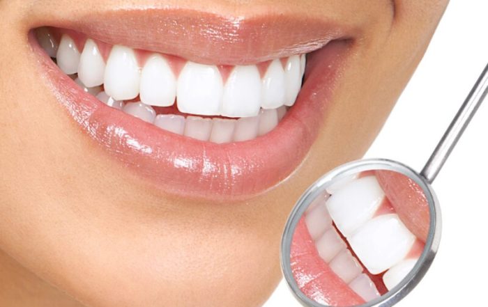 Hollywood smile