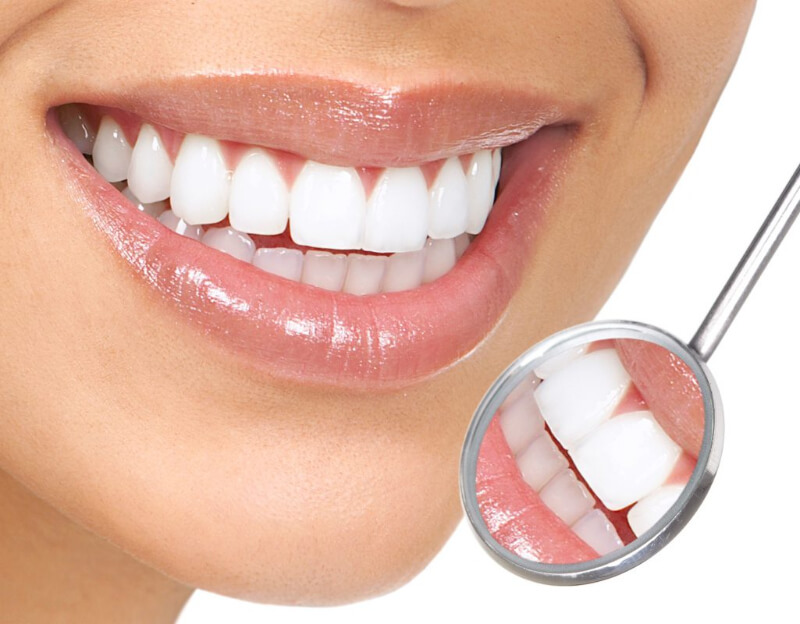 Hollywood smile