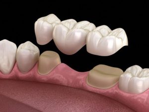 Dental Bridge in Turkey