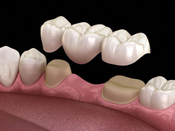 Dental Bridge in Turkey