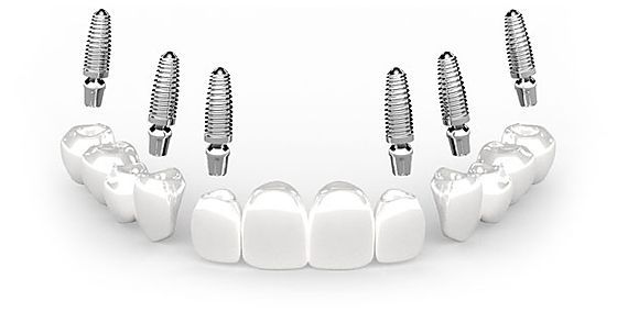 3 on 6 dental implants in Turkey