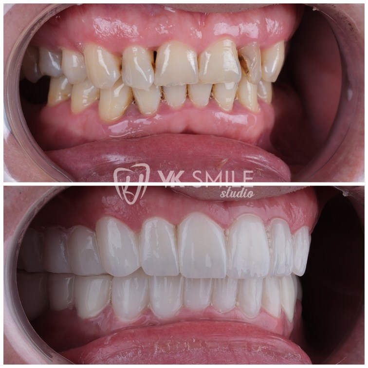 Porcelain crowns restoring chipped molars