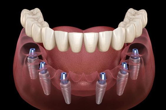All on 6 dental implants in Turkey