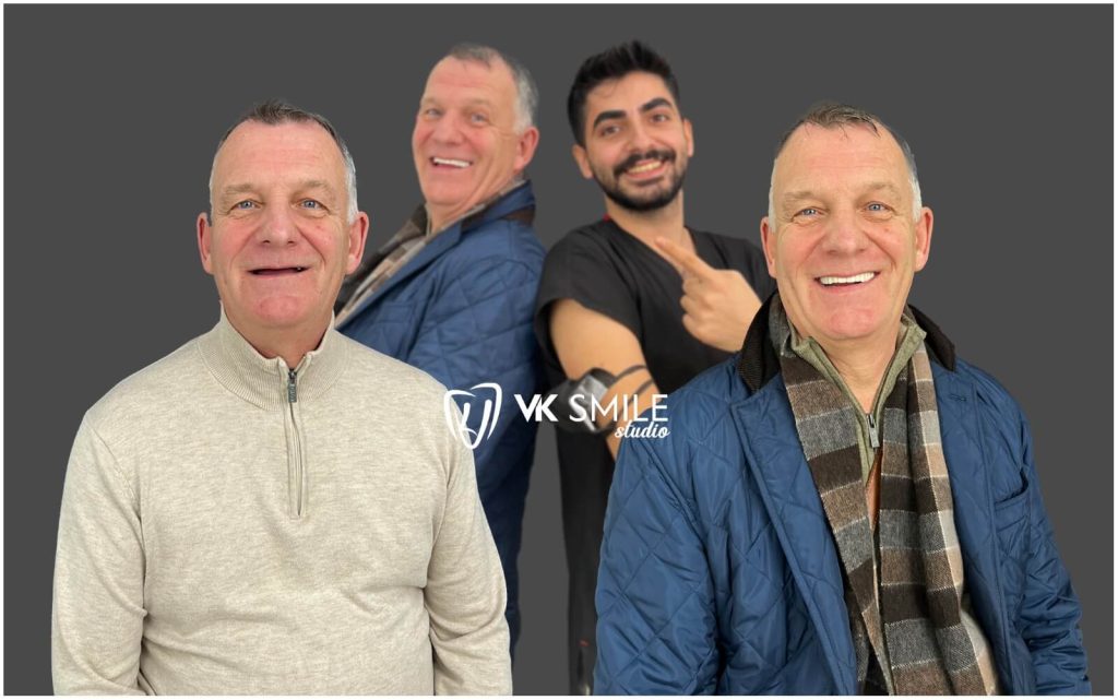 smile procedure All on four dental implants