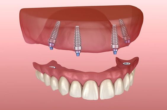 All on 4 dental implants in Turkey