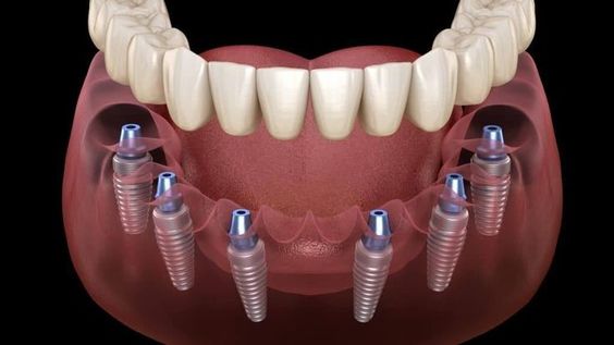 All on 6 dental implants