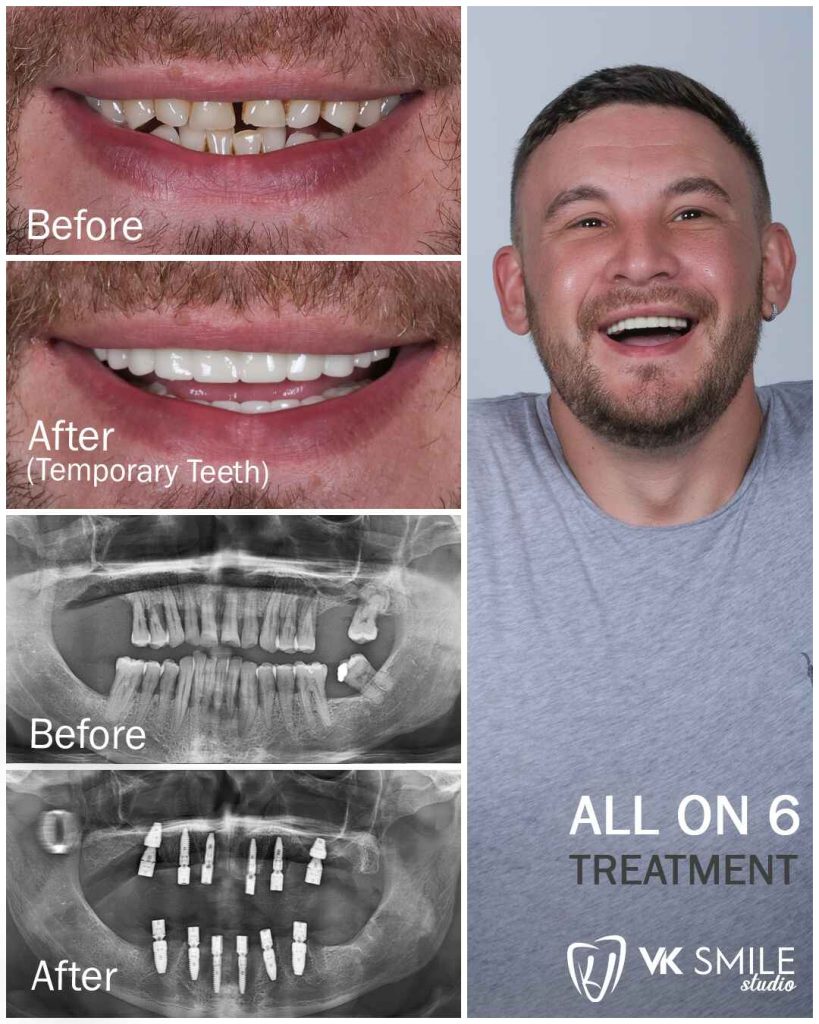 All-on-6 dental implants treatment in Turkey