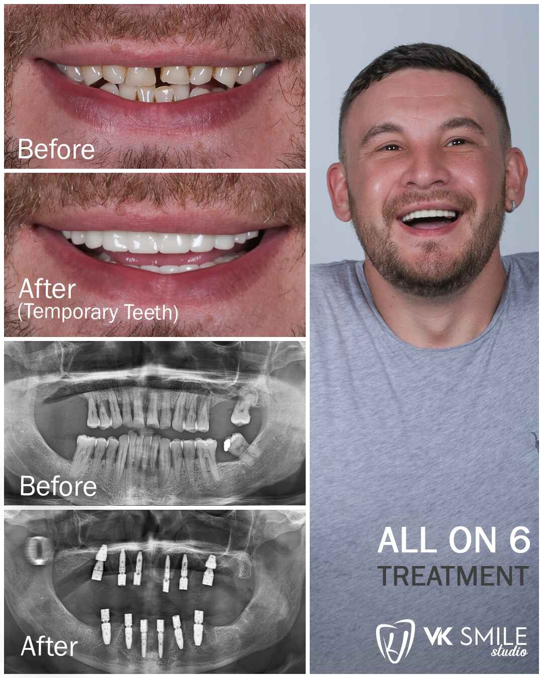 All-on-6 dental implants treatment in Turkey