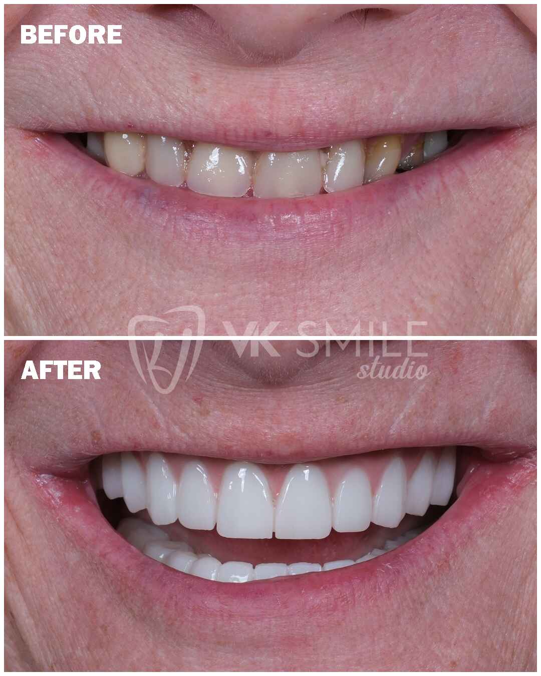 Dental crowns results in Turkey
