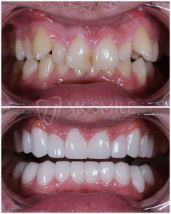 Dental implants before after in Turket