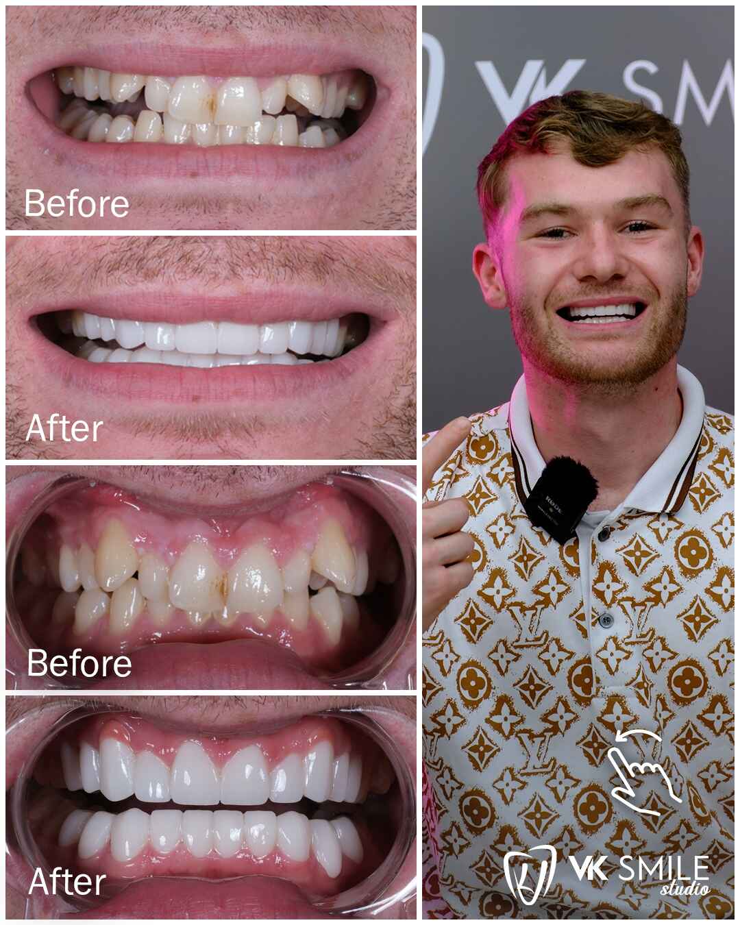 Before After VK Smile Studio (13)