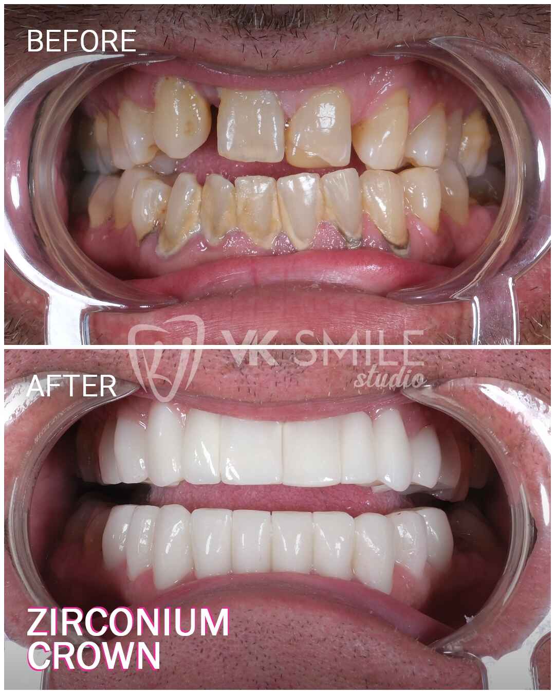 Before After VK Smile Studio (15)