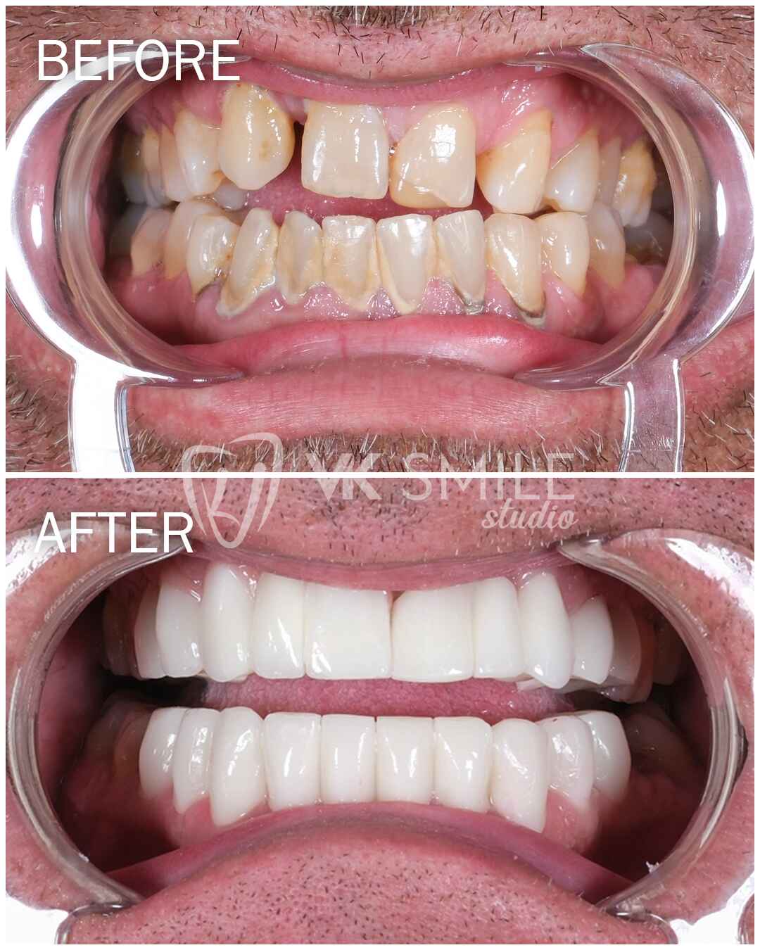 Before After VK Smile Studio (18)