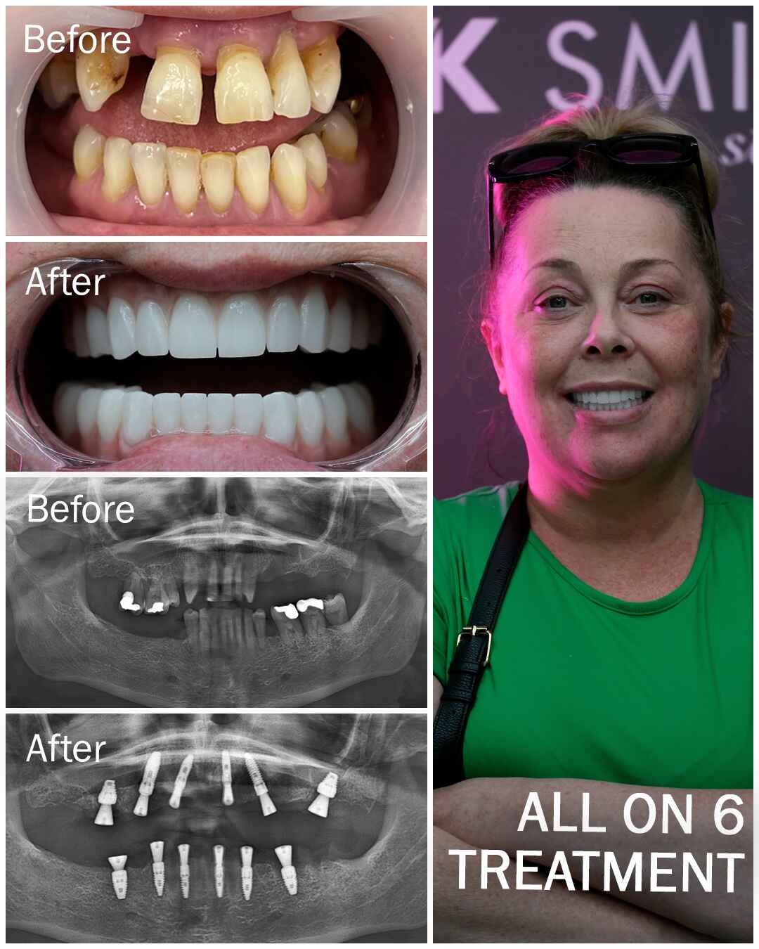 Before After VK Smile Studio (20)