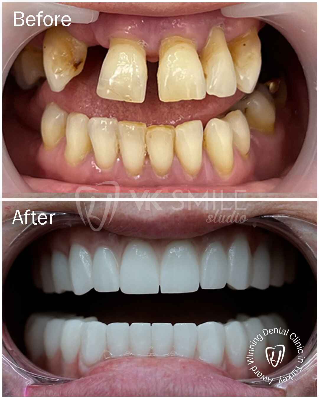 Before After VK Smile Studio (21)
