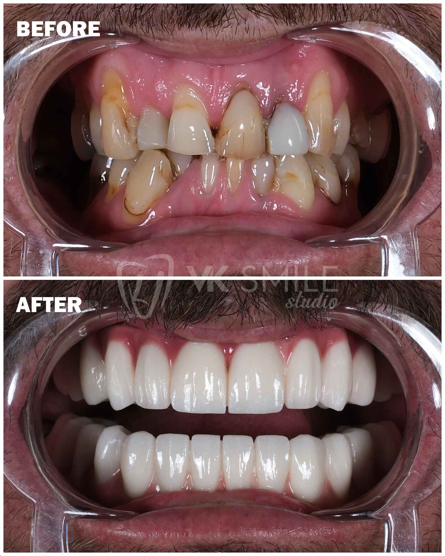 Before After VK Smile Studio (23)