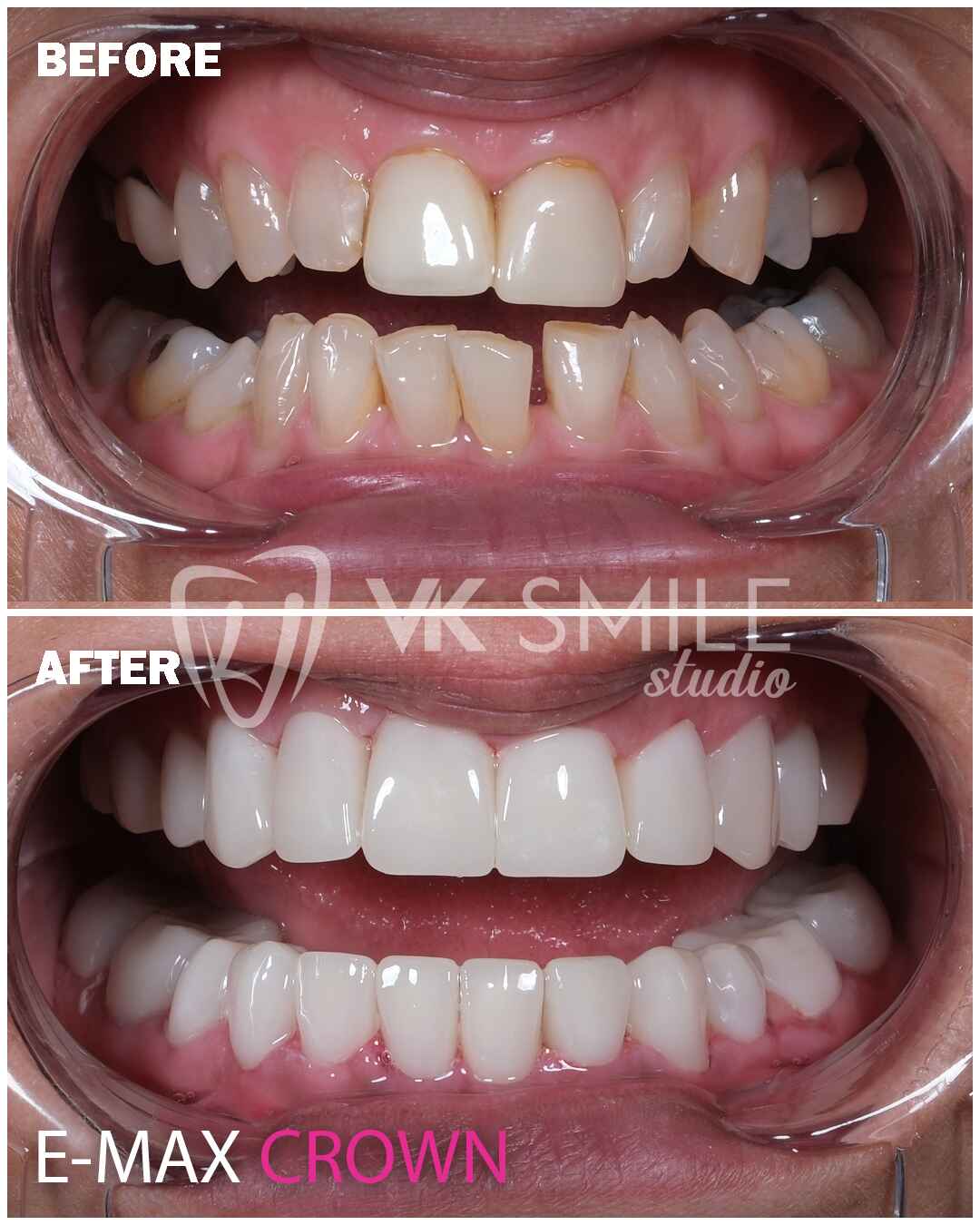 Before After VK Smile Studio (24)