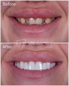 Dental crowns results in Turkey