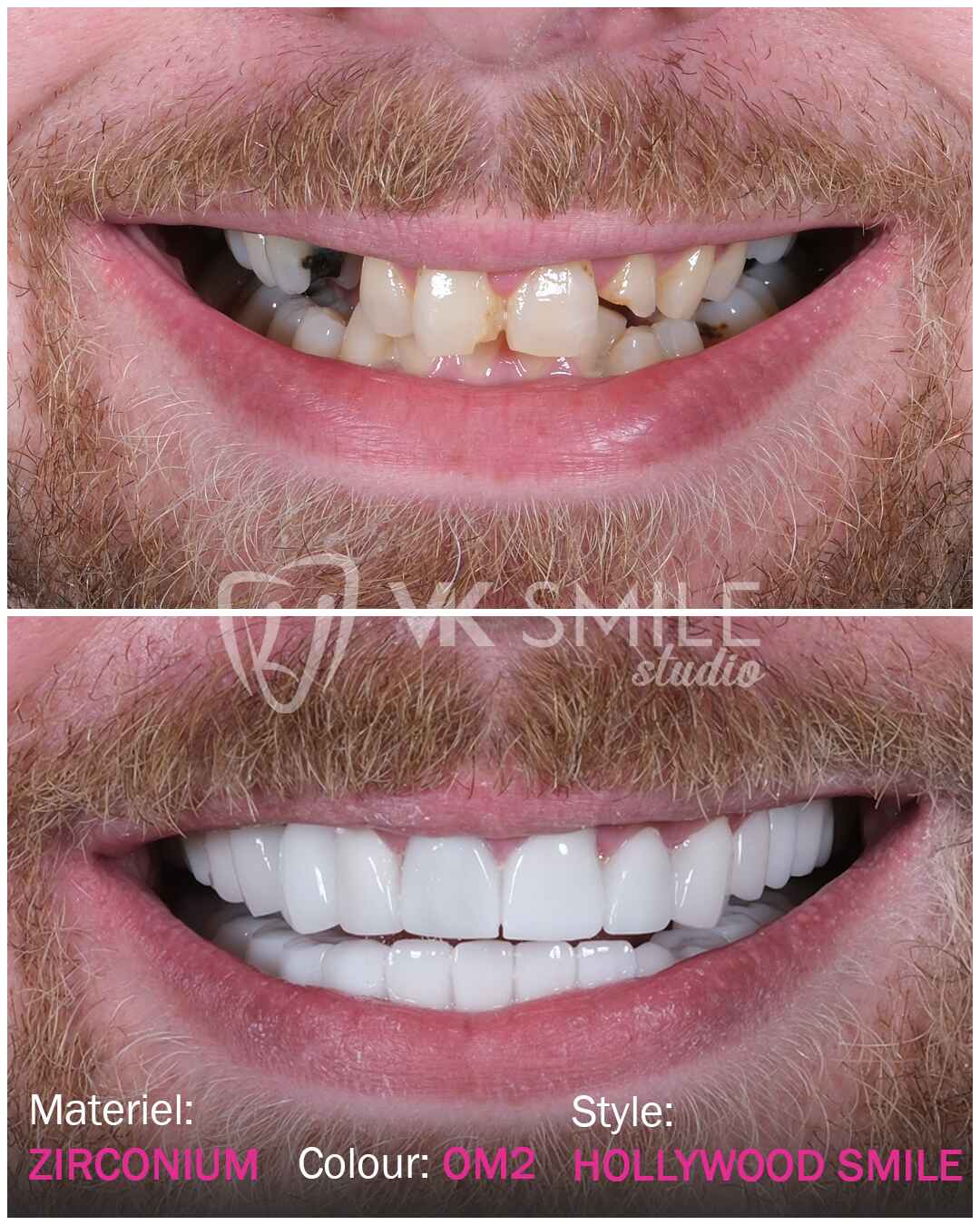 Dental implants before after in Turket