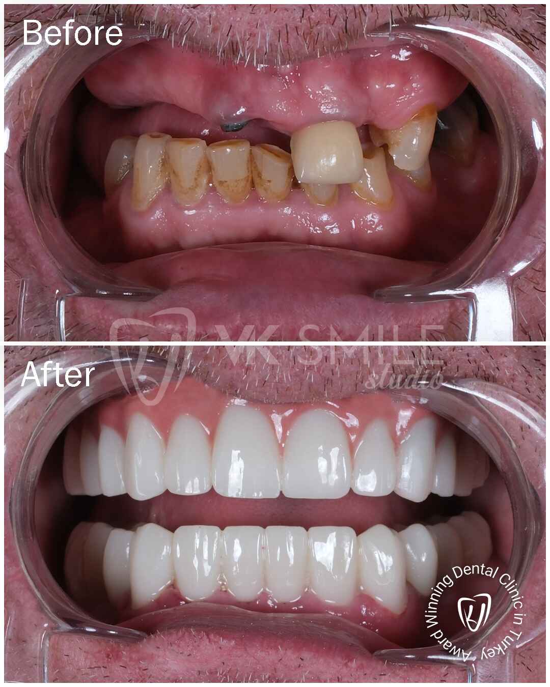 Before After VK Smile Studio (3)