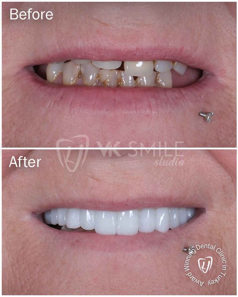 Dental crowns results in Turkey