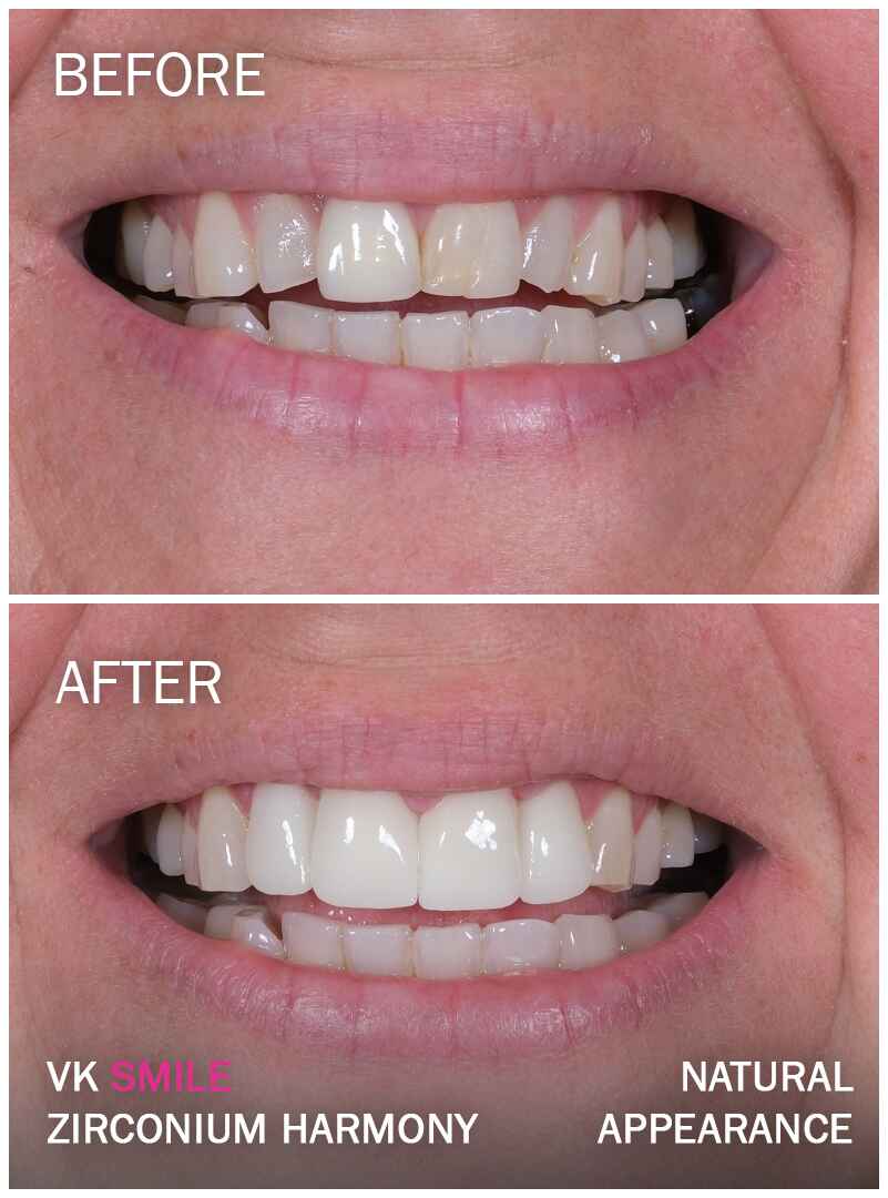 Before After VK Smile Studio (31)