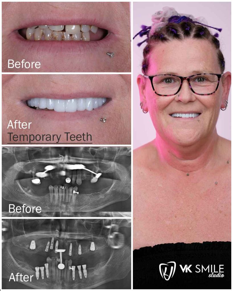 Full Mouth Implants in Turkey