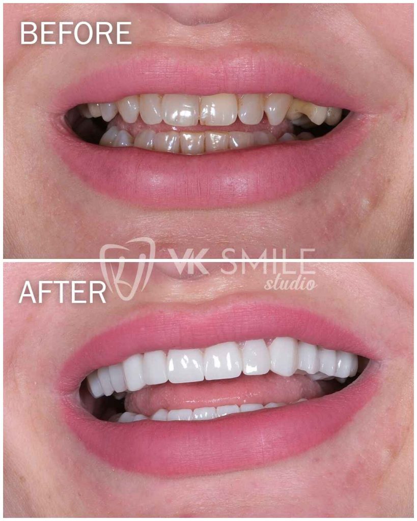 Veneers without shaving teeth before and after photos of the peg laterals case.