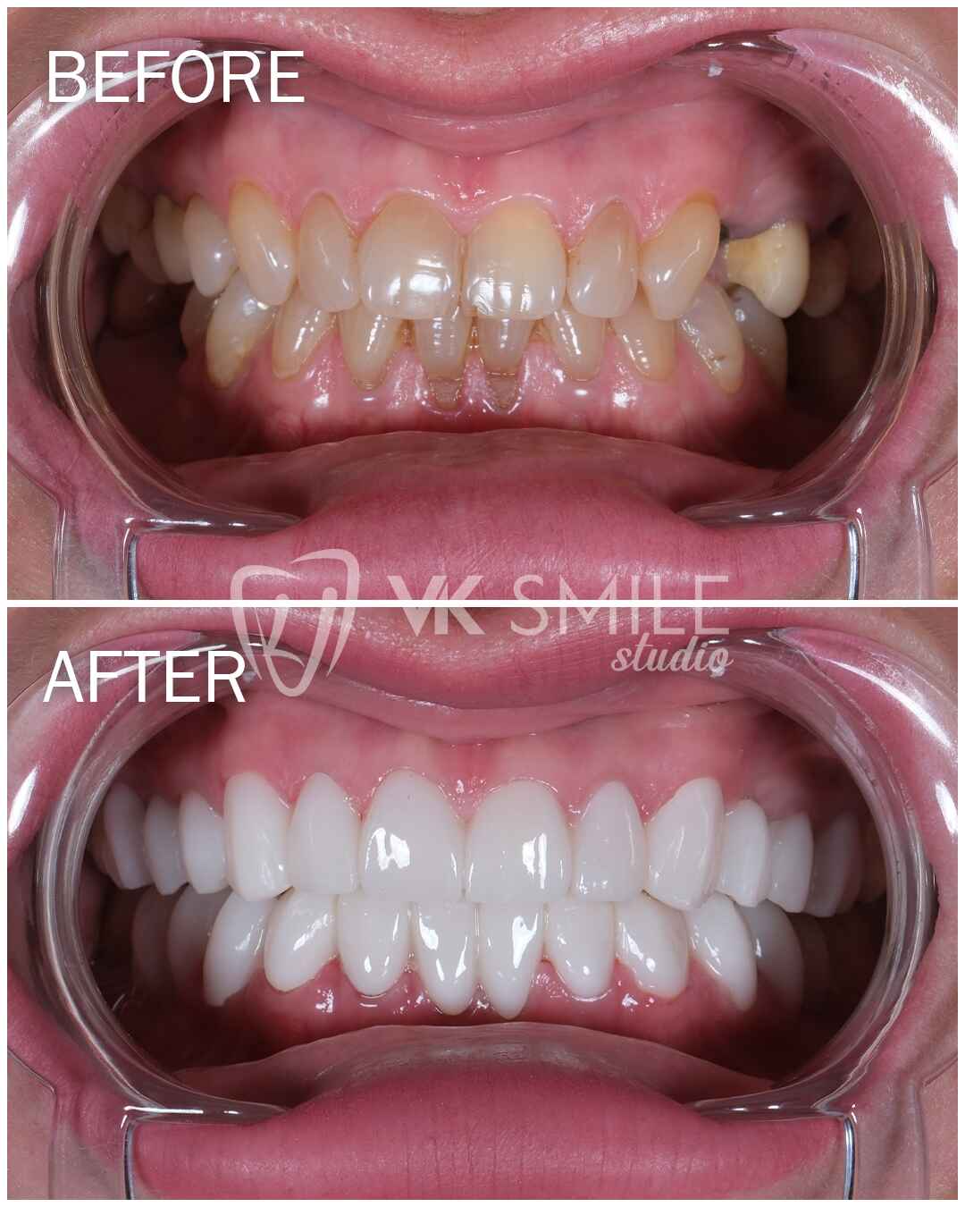 Before After VK Smile Studio (34)