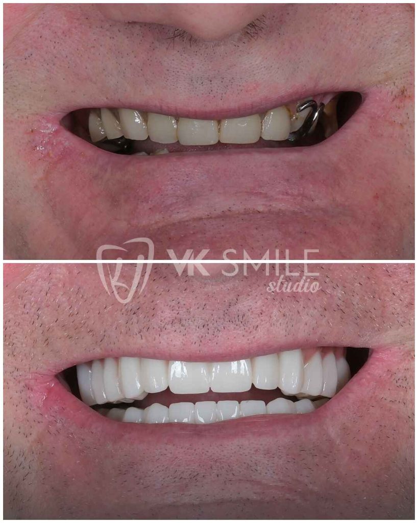 Dental implants in Turkey
