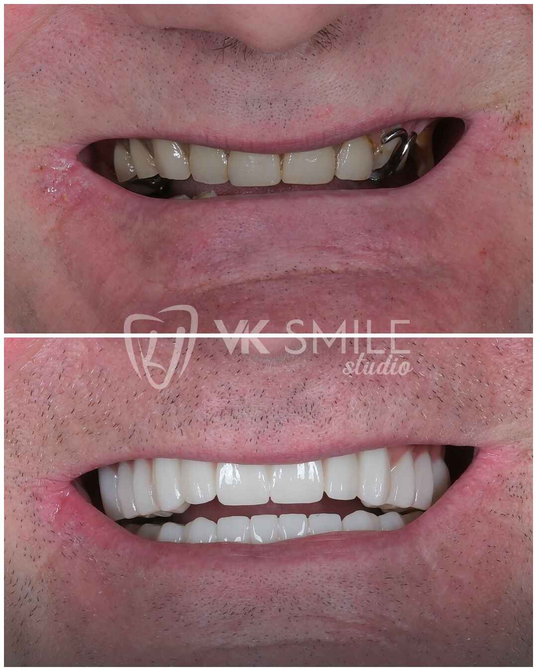 Dental implants in Turkey