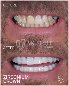 Dental venners before after in Turkey