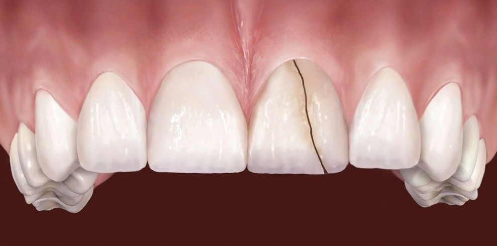 Cracked Teeth Treatment in Turkey: Causes, Symptoms, and Solutions