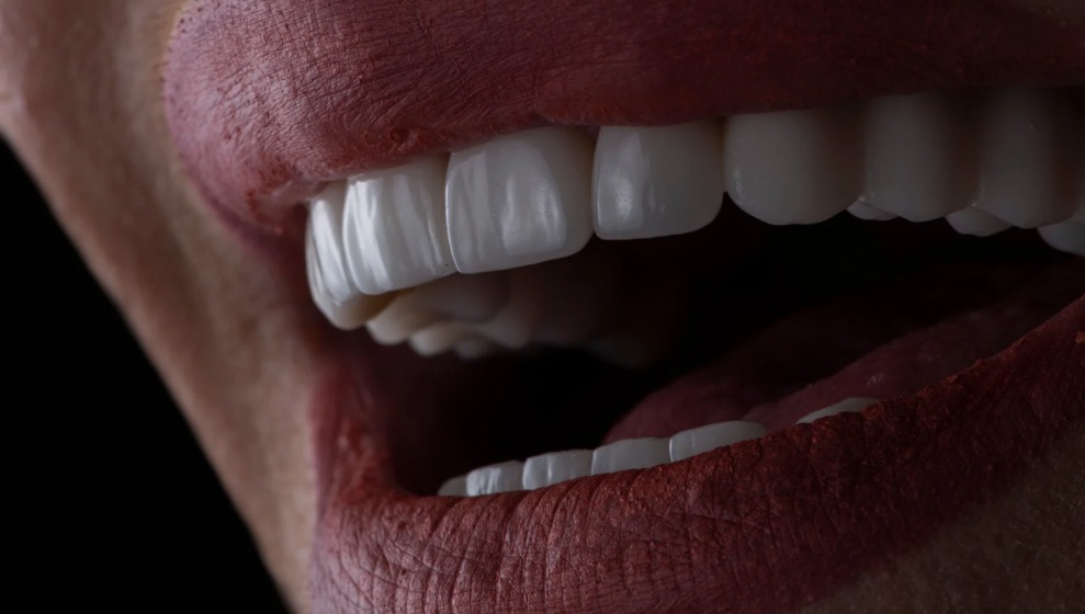 Dental Veneers Turkey