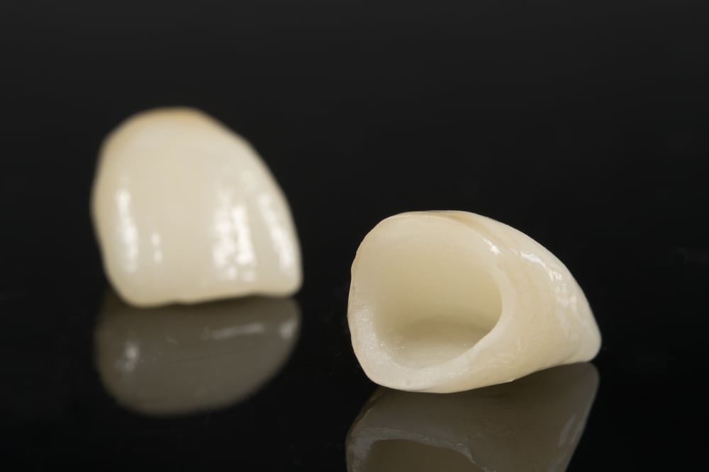 Emax crowns