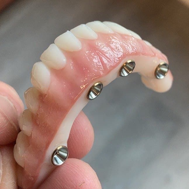 Flapless Dental Implants in Turkey