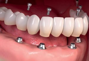 Full Mouth Dental Implants in Turkey