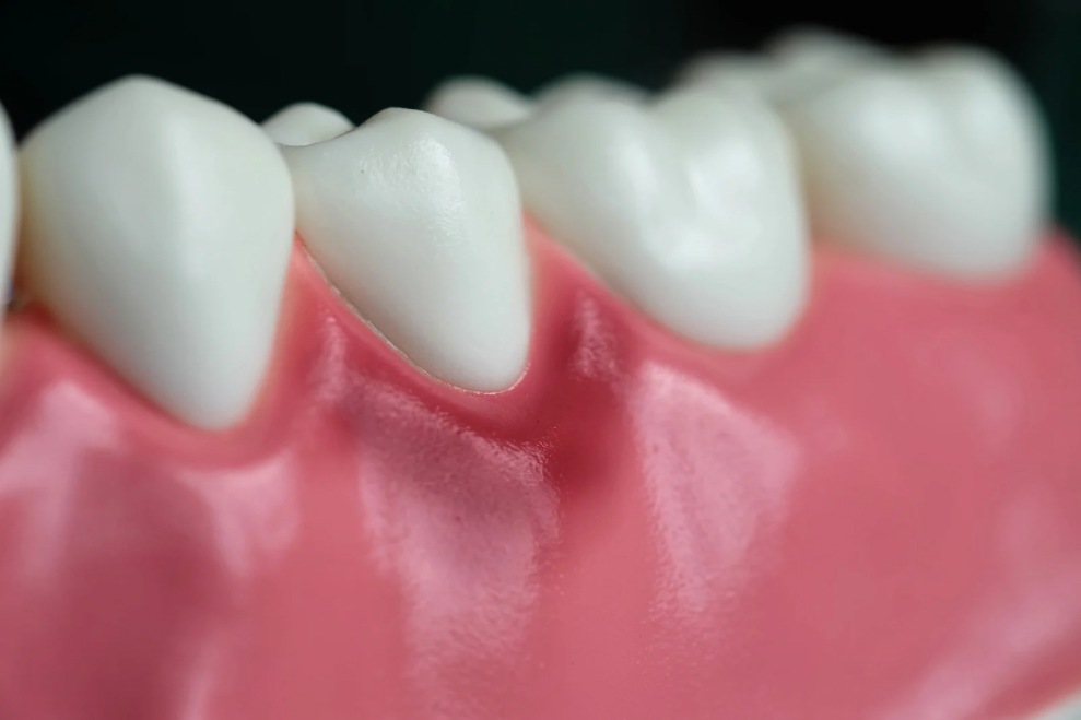 Gingivitis treatment in Turkey