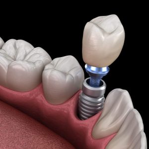 Dental Implants in Antalya, Turkey