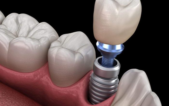 Dental Implants in Antalya, Turkey