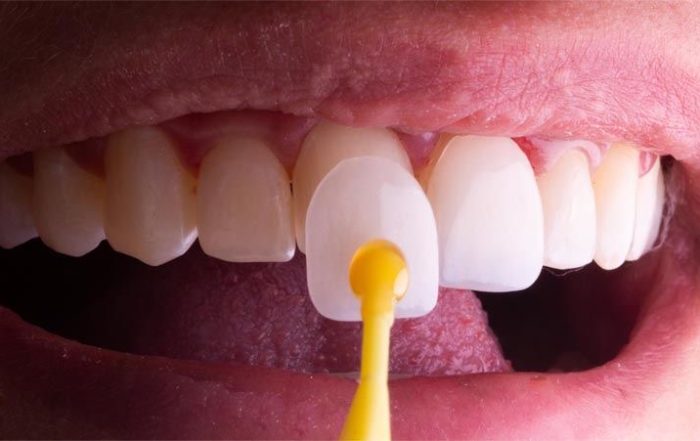 Dental Veneers in Antalya, Turkey