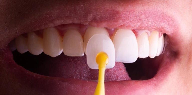 Dental Veneers in Antalya, Turkey