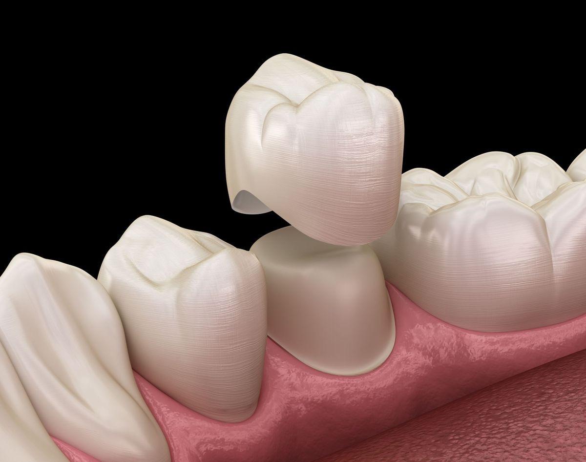 Dental Crowns in Turkey